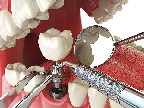 Best Knocked-Out Tooth (Avulsed Tooth) Treatment in North Kansas City, MO